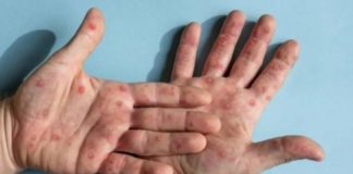 gejala cacar monyet atau penyakit monkeypox